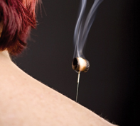Burning moxa on acupuncture needle