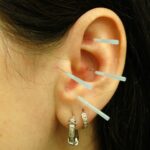 Acupuncture